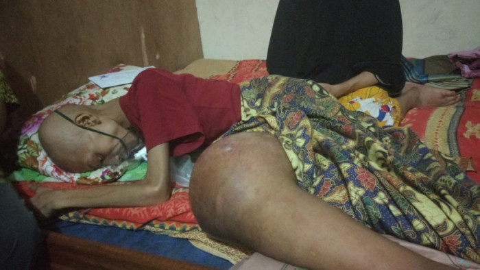 Alfajri Maulana, yang akrab disapa Aji (14), penderita kanker tulang ganas, butuh uluran tangan para dermawan